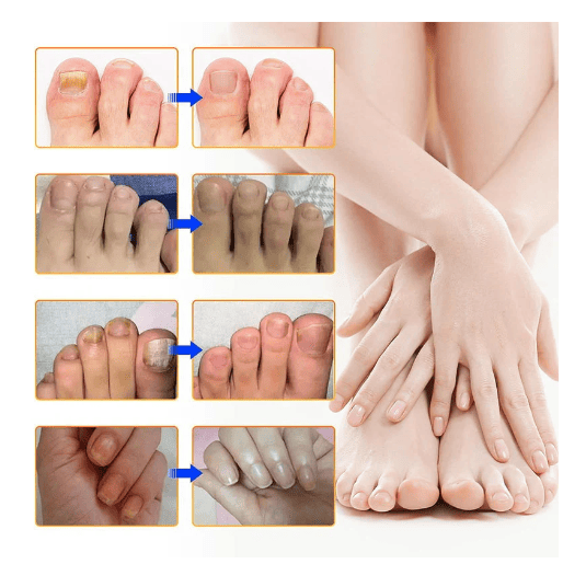 SleepCure Patch réparateur antifongique pour les ongles