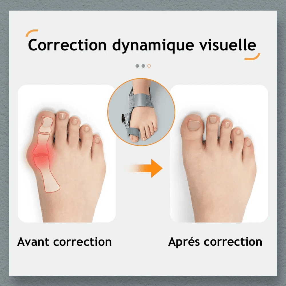 🦶 Attelle Correctrice d’Oignon 💫 Soulage la Douleur et Aide à Réaligner Naturellement Vos Pieds 👣 Confort & Bien-Être au Quotidien ✨