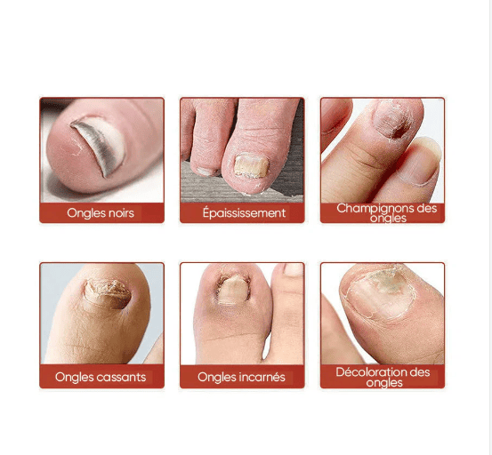 SleepCure  Patch réparateur antifongique pour les ongles