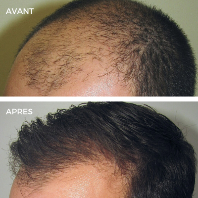 Huile de Batana pour la croissance des cheveux